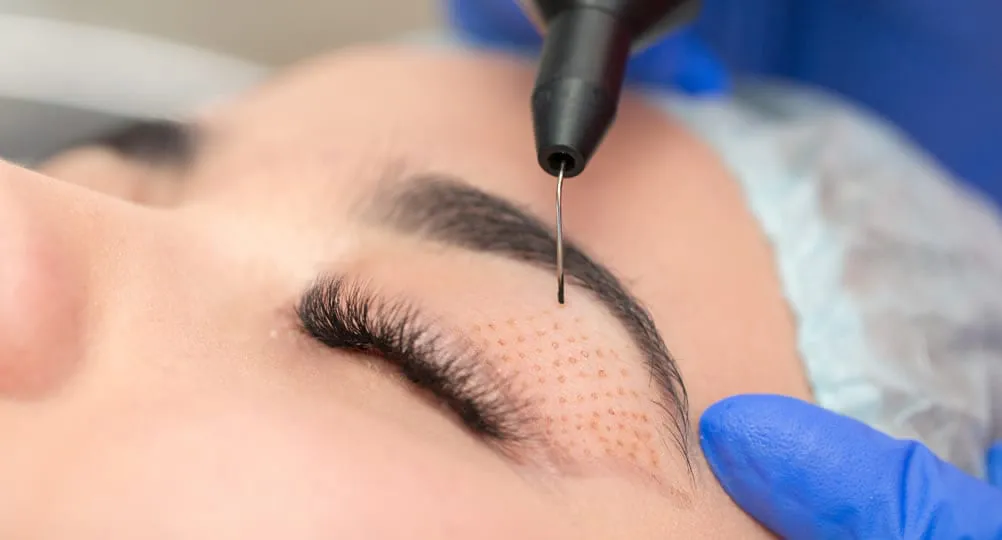 Tratamiento de estética facial con Plasmage
